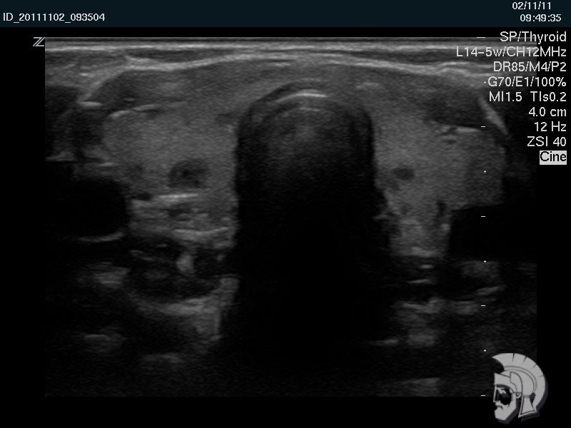 Аутоиммунный тиреоидит